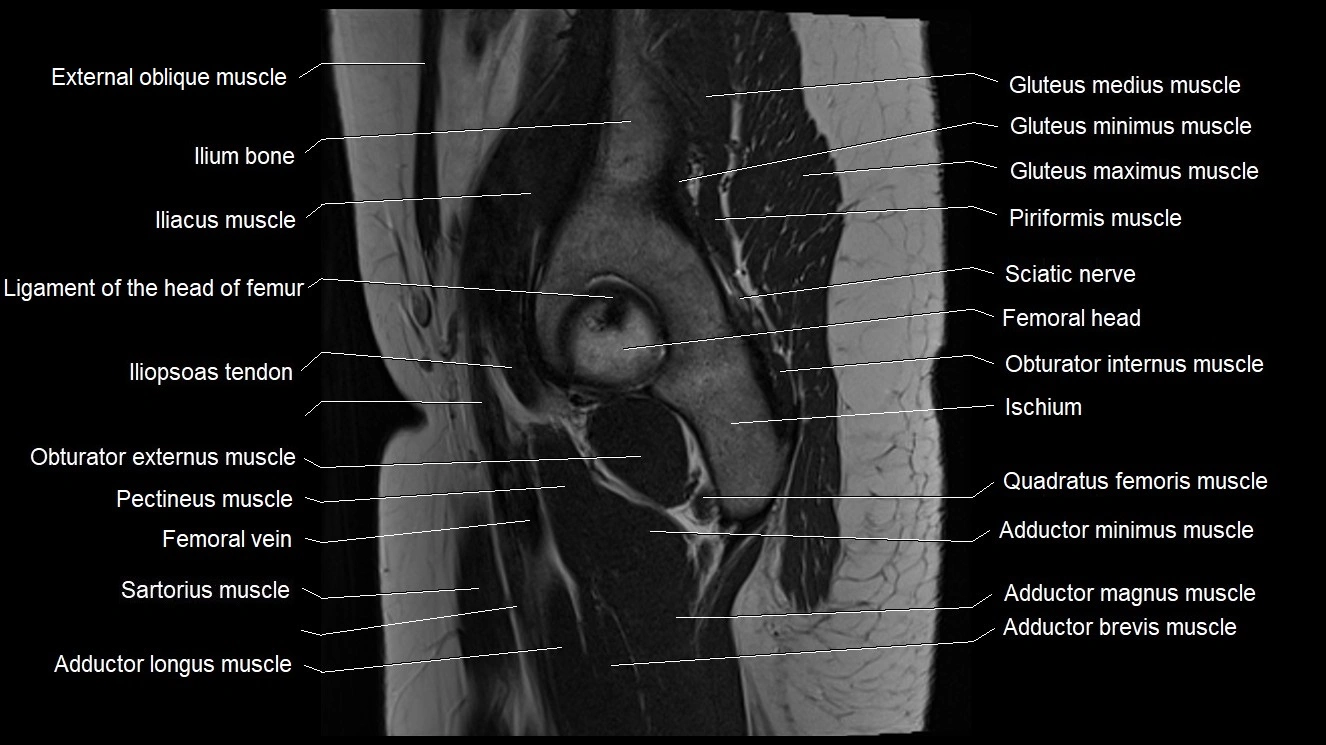 Hip sagittal cross sectional anatomy image 22.webp